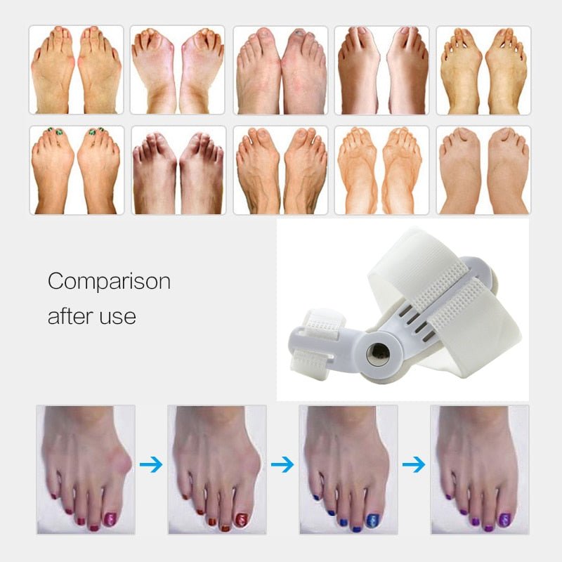 Bunion Corrector™ - FlexSala